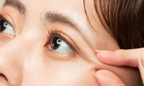 Giải đáp thắc mắc cắt mí mắt có được vĩnh viễn không?